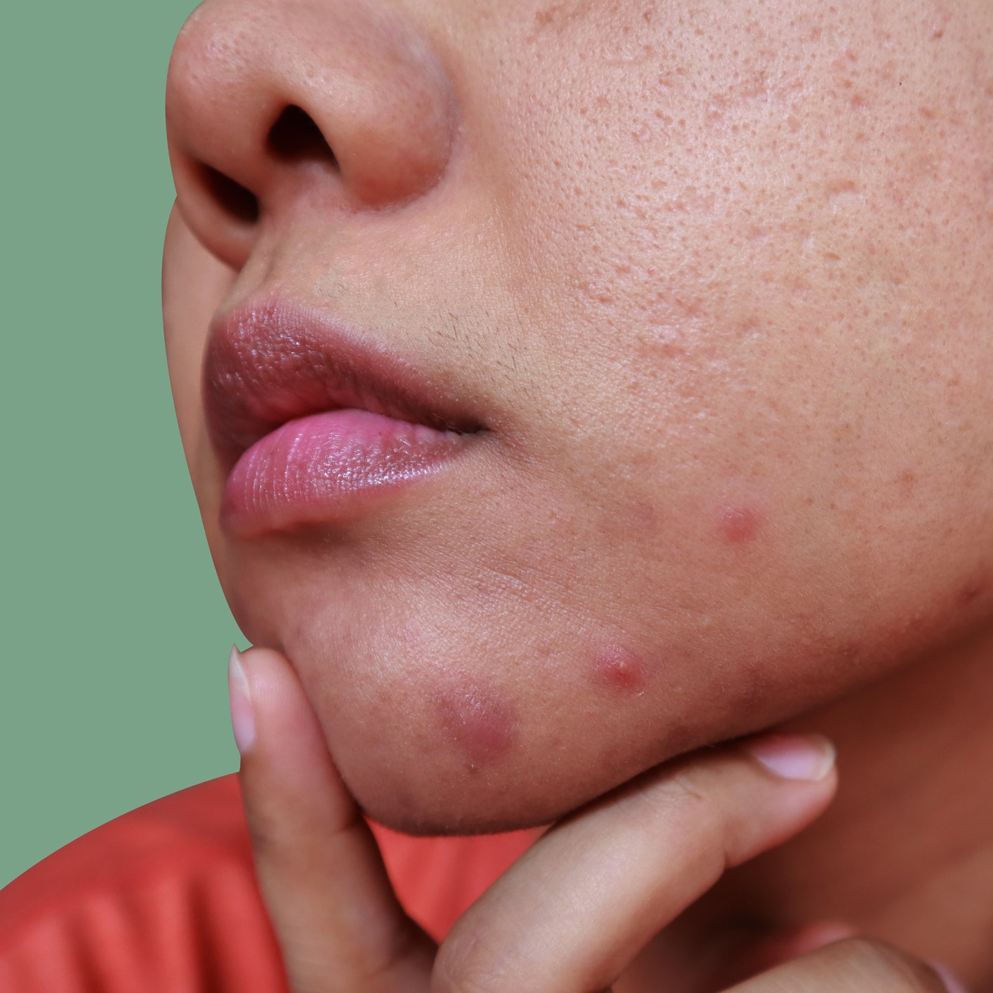 I’m a Grown-Ass Adult&#8212;Why Is Chin Acne Still Ruining My Life?